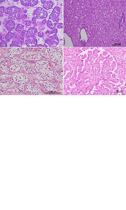 Hereditary renal cell tumors: Clinicopathologic importance