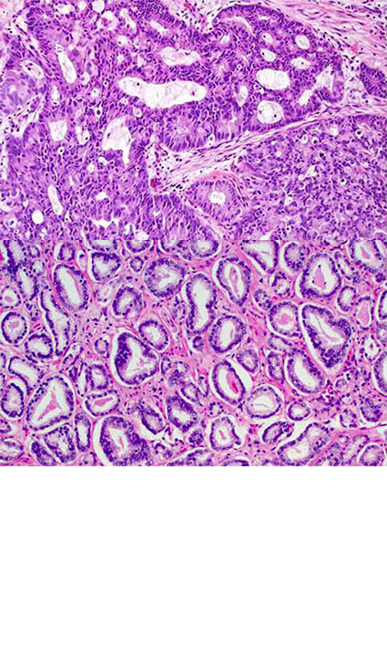 Correlation between serum PSA, gleason score and histopathological grading of adenocarcinoma of prostate in patients undergoing TRUS guided prostatic biopsy ...