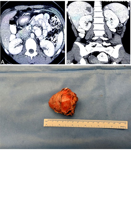 A case of malignant pheochromocytoma of the adrenal gland in a young female