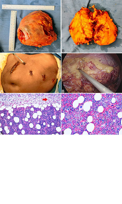 Giant adrenal myelolipoma treated by laparoscopic excision: A case report and review of literature