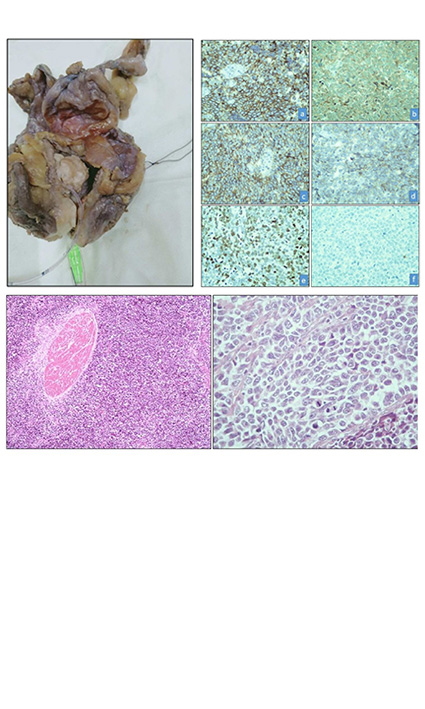 Small Cell Neuroendocrine Carcinoma of the Urinary Bladder: A Rare Entity