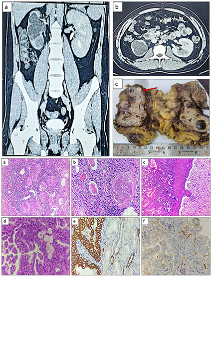 Incidental Detection of Papillary Renal Cell Carcinoma in Nephrectomy Specimen for Chronic Pyelonephritis