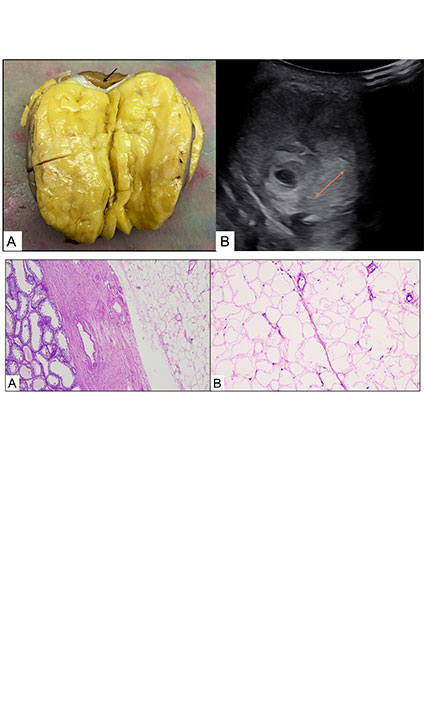 Unveiling the Rarity: A Case Report on Gigantic Primary Scrotal Lipoma