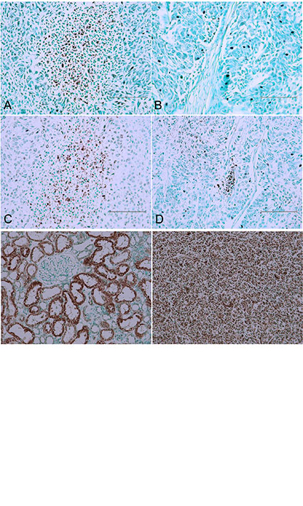 Exploration of Apoptosis in Histopathologies of Balkan Endemic Nephropathies with Both Urothelial Tumour and Atrophied Kidney