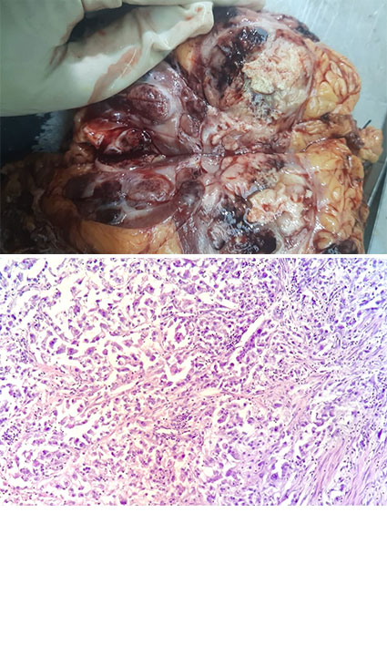 Renal Cell Carcinoma with Sarcomatoid and Rhabdoid Dedifferentiation: Clinico Pathological Significance- Review