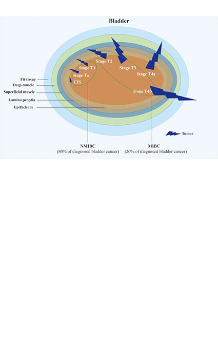 Basic Study on Gene Biology of Bladder Cancer Metastasis