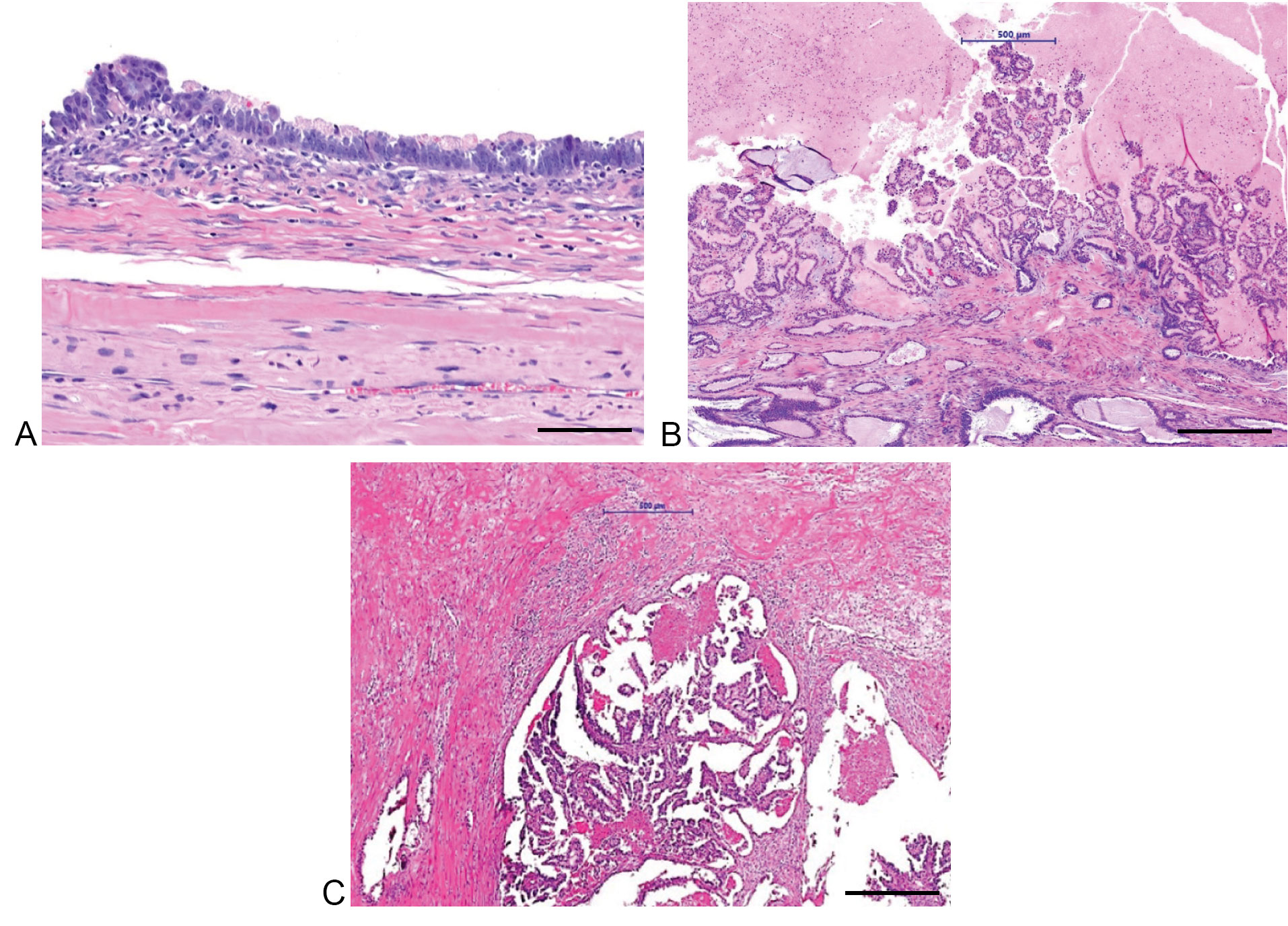 ovarian-type-tumors-mullerian-tumors-of-the-testis-clinicopathologic