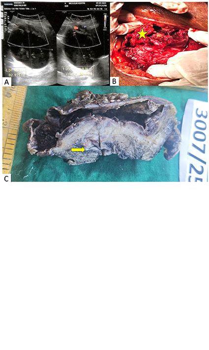 A Diagnostic Twist: Primary Bladder Adenocarcinoma Masquerading as an Ovarian Torsion: A Case Report on Unusual Cystic Presentation