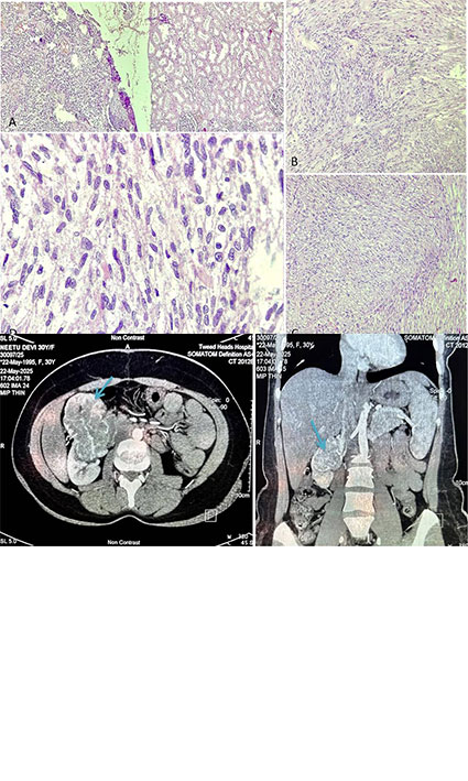 Incidentally Discovered Primary Renal Leiomyosarcoma in a Middle Aged Female Presenting with Symptoms of Incomplete Abortion: A Rare Case Report