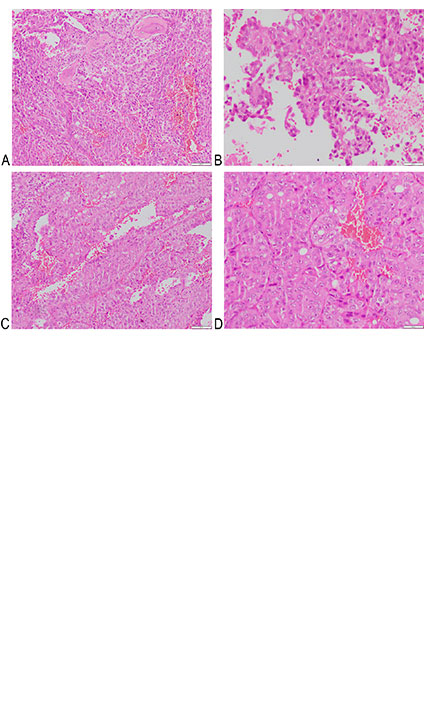 Eosinophilic Solid and Cystic Renal Cell Carcinoma Presenting as Bone Metastasis: A Case Report and Literature Review 