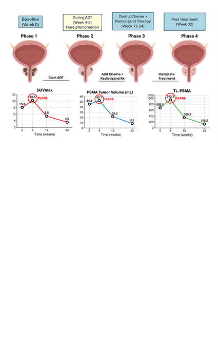 Prostate-Specific Membrane Antigen (PSMA) PET-CT: Revolutionizing Staging, Restaging, and Treatment Response Assessment