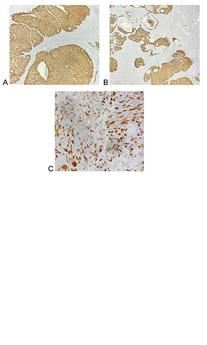 Adenoid Cystic (Basal Cell) Carcinoma of the Prostate: A Rare Entity with Diagnostic Challenges and Therapeutic Uncertainty