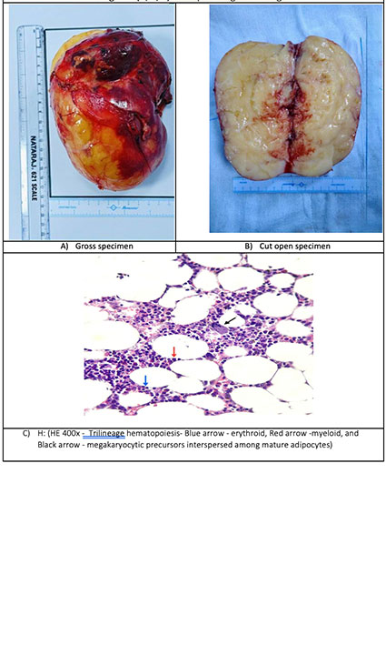 Robot-Assisted Adrenalectomy for a Giant Adrenal Myelolipoma: One of the Largest Tumors Removed by a Minimally Invasive Approach