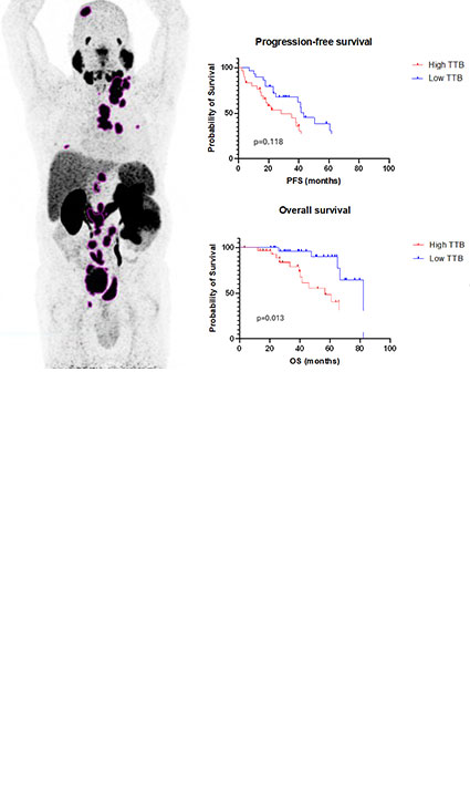 68Ga-PSMA PET/CT-avid Tumour Volume: A Potential Prognostic Biomarker in Metastatic Hormone Sensitive Prostate Cancer