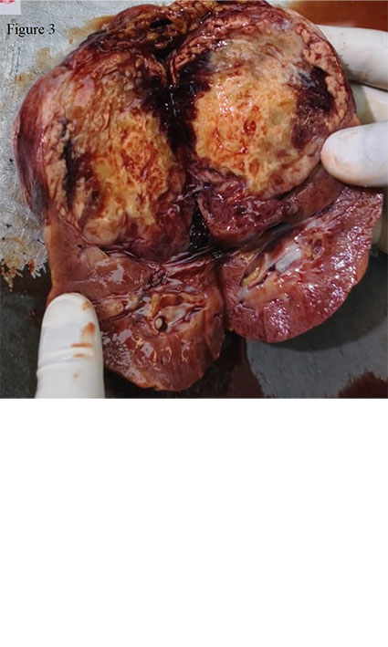 A Better Multidisciplinary Approach in Treatment and Prognosis for Stage IV Renal Cell Carcinoma
